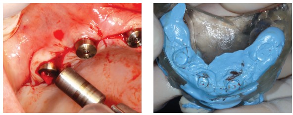 Figure 18 (left): A tissue punch was used to adjust the gingiva; Figure 19 (right): The surgical guide was rebased with Jet Blue Bite to register the occlusion