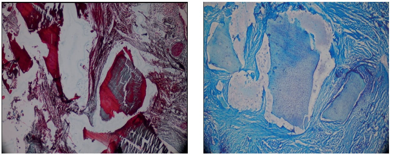 Tooth derived bone graft — an alternative for socket preservation