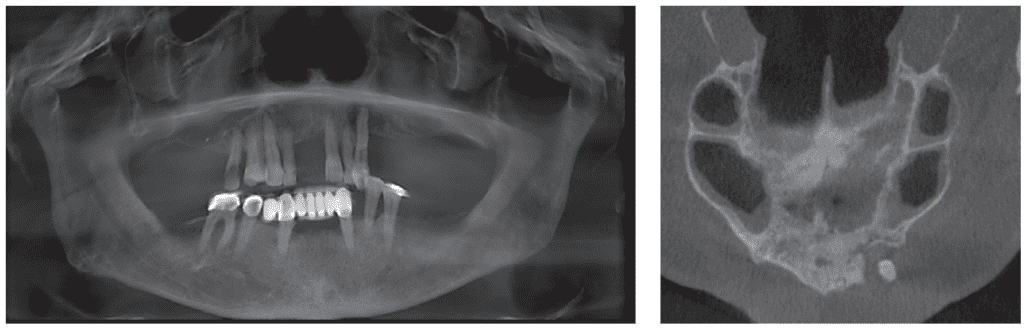 PATZI protocol — for severely atrophic maxillae