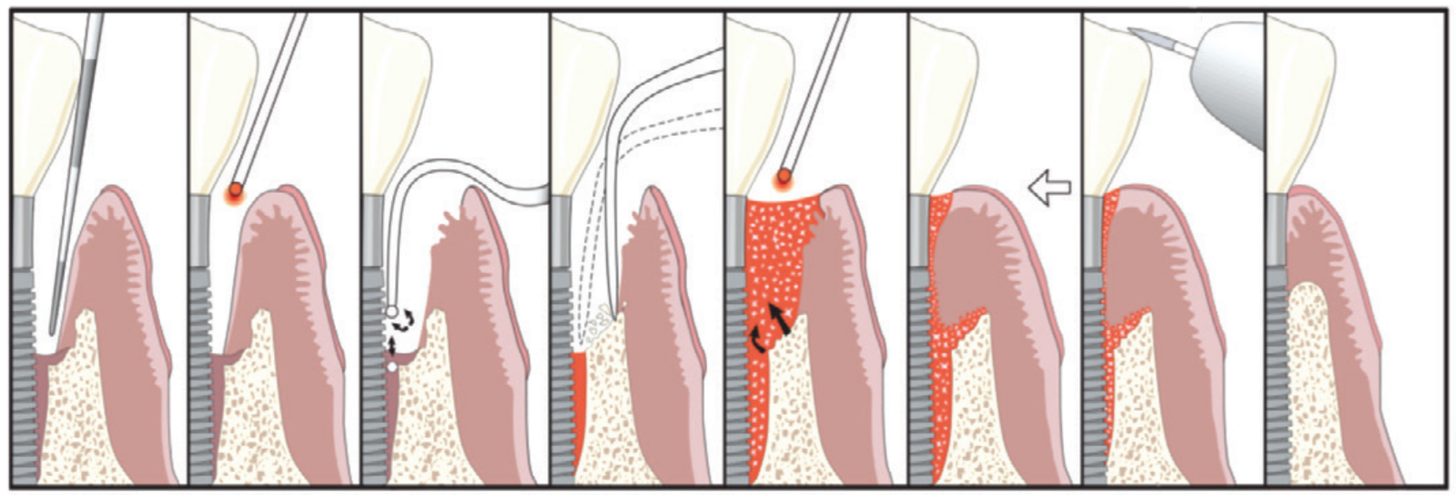 figure 1 with the lapip protocol, laser energy vaporizes bacteria, diseased tissue, and contaminants in soft tissue.