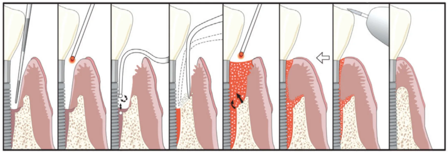 figure 1 with the lapip protocol, laser energy vaporizes bacteria, diseased tissue, and contaminants in soft tissue.