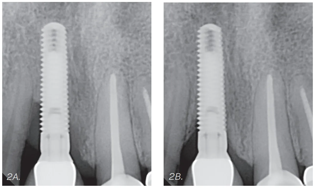 figures 2a and 2b 2a. preoperative x ray. 2b. postoperative x ray