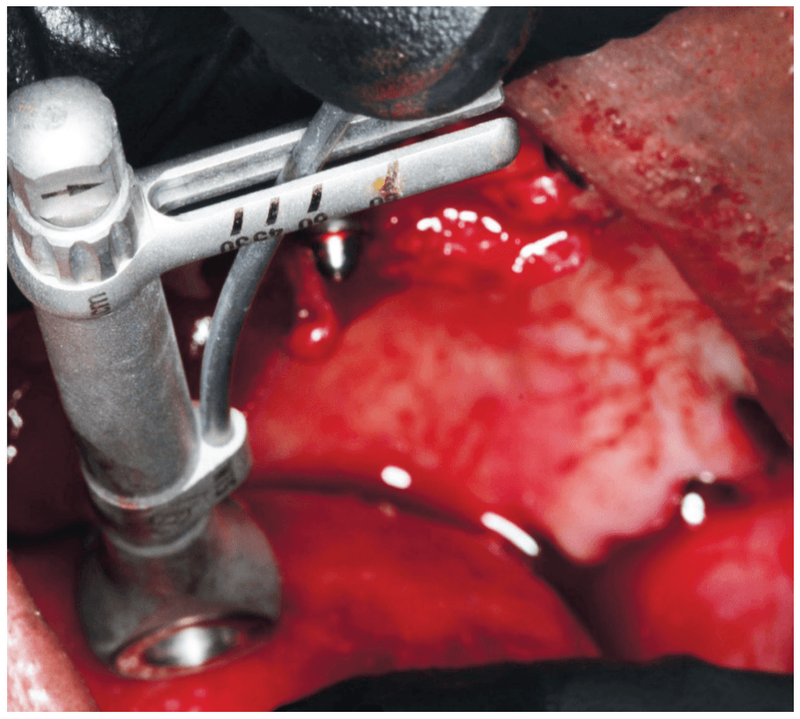 figure 8 implants placed using the palatal root approach can obtain high
