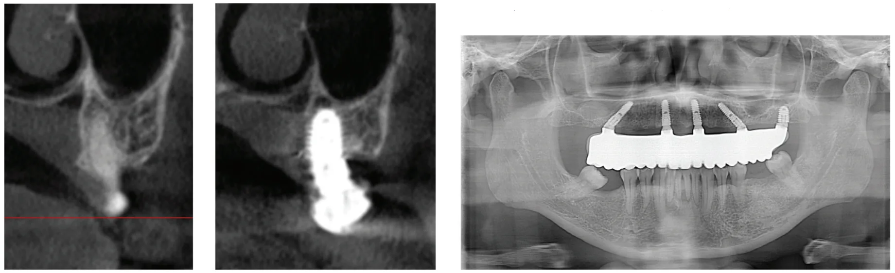 Full-arch implants — guidelines for better outcomes